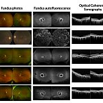 Images of multiple forms of retinal dystrophy from the study