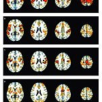 Image showing differences in subcortico-cortical connectivity in youth with and without ADHD.