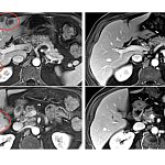 Image of an MRI scan showing shrinkage of multiple liver metastases from a patient with rectal cancer.