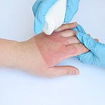 A doctor's hands treating a hand with second degree burns.