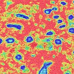 Tissue samples showing substantial stromal disruption in the breast. 