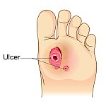 Scientists identify diagnostic aid to determine risk of diabetic foot ulcer recurrence Scientists identify diagnostic aid to determine risk of diabetic foot ulcer recurrence
