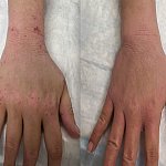 Two photos of the same hand. On the left, the skin has a red rash. On the right, the skin does not.