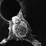 Scanning electron micrograph of cancer cell