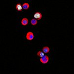 Tumor cells color red and blue.