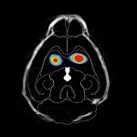 Brains of mice injected with misfolded alpha-synuclein have less dopamine.