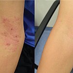 Photos of elbow with eczema before treatment and without eczema afterward