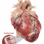 Temporary pacemaker mounted on the heart. Temporary pacemaker mounted on the heart.