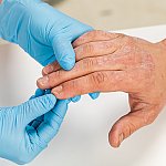 Dermatologist wearing gloves examines the skin of a patient with eczema