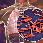 Mycobacterium tuberculosis bacteria in lungs.