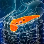 Illustration of pancreas with tumors.