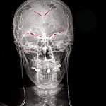 A-ray shows recording devices in both shoulders and electrodes at the top of the brain and above the eye sockets.