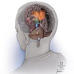 Illustration showing a lead implanted in the lower rear of the brain and stimulating nerves that connect to other brain regions.
