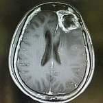 MRI of a gliblastoma.