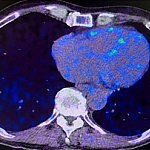 Heart PET scans from a study participant