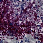 Microscope image of purple-stained bacteria throughout a tumor.