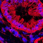 Microscope image of abnormal pancreatic ducts.