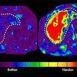 Two liver elastograms.