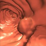 Computer generated image of a colon polyp.