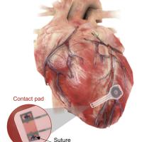 Temporary pacemaker mounted on the heart. 