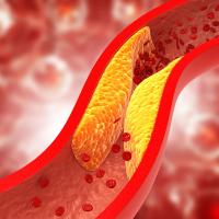 Illustration of an artery clogged by plaque