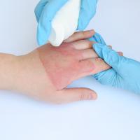 A doctor's hands treating a hand with second degree burns.