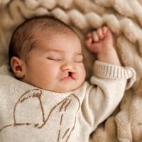A baby with a cleft lip lying on its back on a blanket