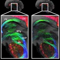 colorful tractography image of the brain showing a before and after using different scanners