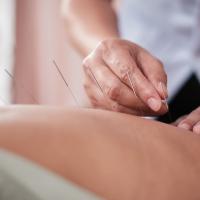 Acupuncture treatment to the back. 