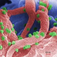 Scanning electron micrograph shows HIV as tiny green spheres scattered atop the surface of a lymphocyte cell.