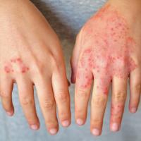 A close-up of hands with atopic dermatitis.
