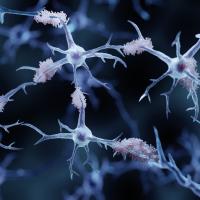 3-D illustration of amyloid plaques and neurons.