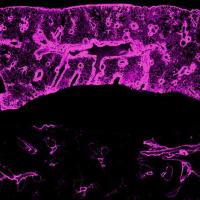A lung transplanted between genetically identical mice became filled with a substance called hyaluronan (pink, top half of image), which could contribute to transplant rejection. A treatment that boosted growth of lymphatic vessels led to a marked reduction in hyaluronan (bottom half of image).