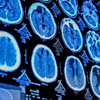 A close-up of a brain scan on a medical imaging monitor.