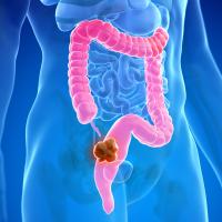 An illustration of the colon with a highlighted diseased area.