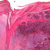 Microscope view of malignant melanoma 