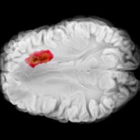 Axial view of the brain showing a glioblastoma in the left frontal lobe with central necrosis, peripheral infiltration, and early midline shift