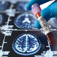 Close-up shot of a medical professional holding a blood sample vial over brain scan images