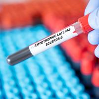 Gloved hand holding a blood-filled tube labeled Amyotrophic Lateral Sclerosis