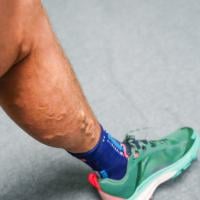 A close-up of a man's leg with varicose veins.