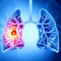 An illustration of lungs with a cancerous tumor on the left side. 