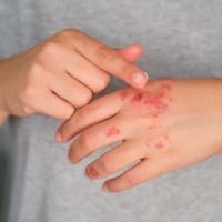 A close-up of a person applying ointment to psoriasis on their hand.