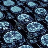 Photo of multiple brain images from MRI scans.