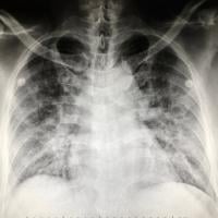 X-ray of the human lung. 