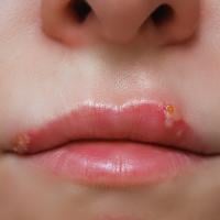 A close-up of a person's lips showing small blister-like lesions on the upper lip, representing cold sores.