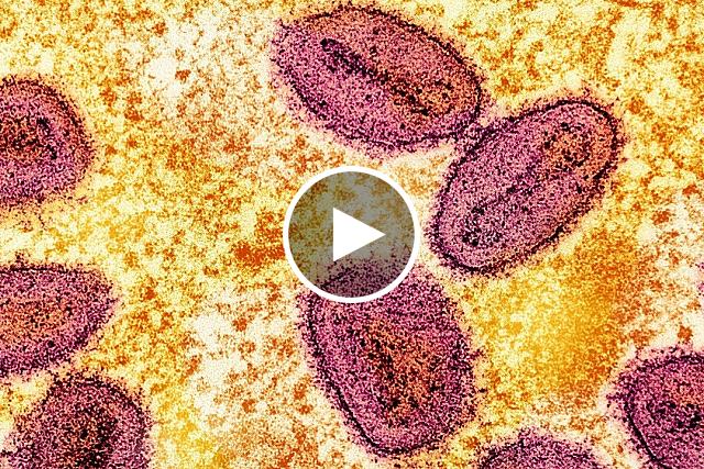 On September 17, 2024, the National Institute of Allergy and Infectious Diseases (NIAID) released an update on research priorities to improve our understanding of mpox, and the various clades, or strains, of the virus that causes mpox. Dr. Jeanne Marrazzo, director of NIAID, discusses these priorities, and the urgent need for better tools to fight this devastating illness.