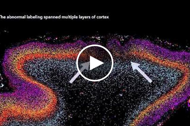 Patches of Disorganization in the Neocortex of Children with Autism.