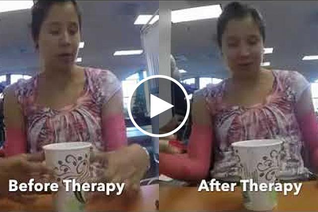 This video from the Edgerton Lab at UCLA shows activity before and after the stimulation therapy.