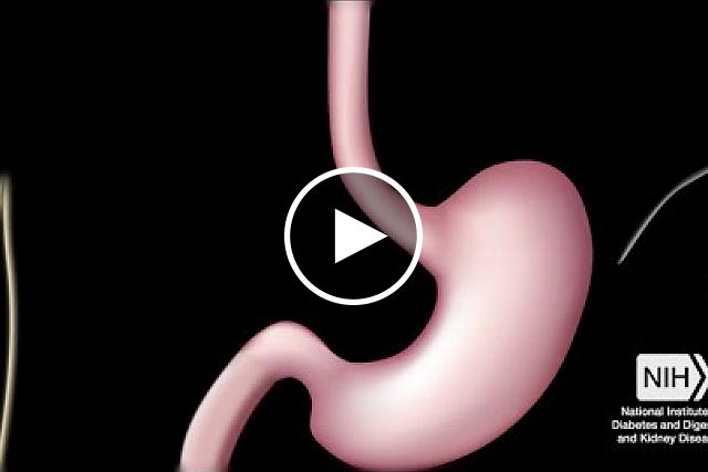 NIDDK: What is Bariatric 