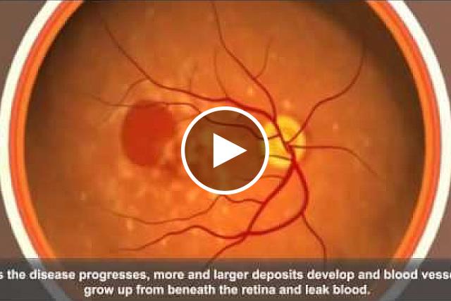 Animation: Age-Related Macular Degeneration